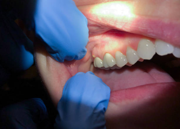 Best Emergency Dentist for Lost Fillings or Crowns in Somerdale, NJ
